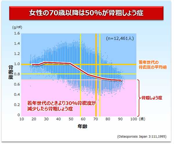 女性の70歳以降は50%が骨粗しょう症